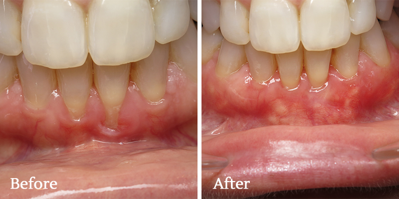 Before and After Photos
