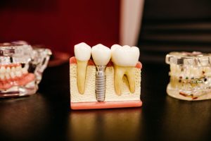Teeth Photo