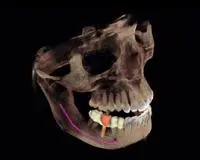 Teeth x-ray